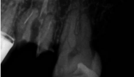 Dente 27, radiografia inicial
