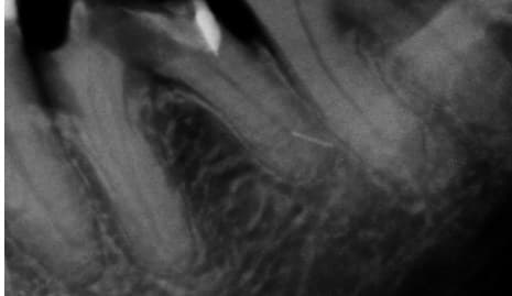 Dente 36, radiografia inicial