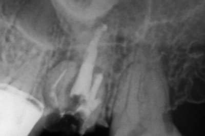 Dente 27, radiografia final