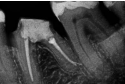 Dente 36, radiografia final