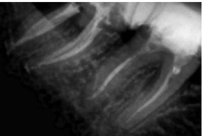 Dente 47, radiografia final